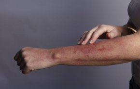 آفات جلدية لدى مرضى كورونا قد تكون علامة على مشكلة صحية أخرى

