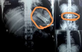 العثور على هاتف محمول في معدة مواطن مصري!