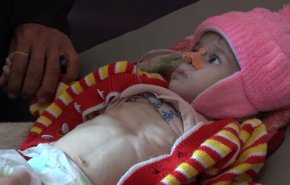 شاهد: خبر مفجع.. فقدان جيل كامل من اطفال اليمن!