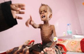 الصحة اليمنية:  السعودية تسببت في أكبر مأساة إنسانية لأطفال اليمن
