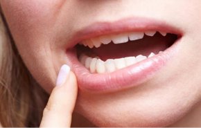 علاج فطريات الفم واللسان بالاعشاب الطبية