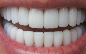 كيفية إزالة الجير من الأسنان بطرق طبيعية