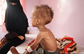 وكالات أممية : سوء التغذية الحاد يهدد نصف أطفال اليمن