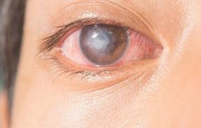 إصابة رجل بقطع في قرنية العين بسبب الكمامة