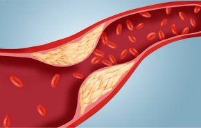 علامات تكشف عن ارتفاع نسبة الكوليسترول في الدم
