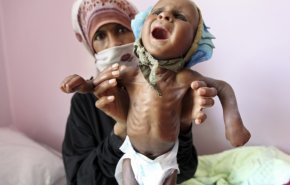 طفل يمني يموت كل 5 دقائق جراء استمرار العدوان والحصار
