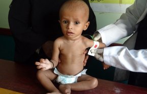 «الصحة العالمية»: 75% من أطفال اليمن يعانون سوء التغذية المزمن 