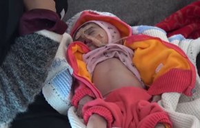 شاهد..المجاعة تنهش اطفال اليمن 