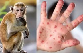 المكسيك تعلن عن تسجيل أول إصابة بجدري القردة