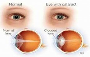 طبيب عيون يوضح كيفية التعرف على إعتام عدسة العين مبكرا
