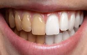  طرق لابتسامة هوليوودية دون تبييض الأسنان