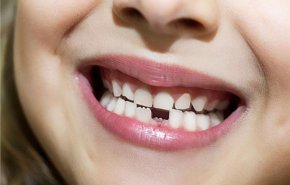 قريبا.. دواء ياباني يعيد نمو الأسنان المفقودة