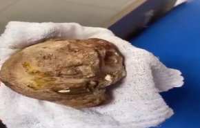 بالفيديو.. رفع حصى بوزن 950 غراما من مثانة رجل ثلاثيني!