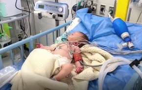 انتشار مرض الشلل التصاعدي (GBS) بين الأطفال في قطاع غزة