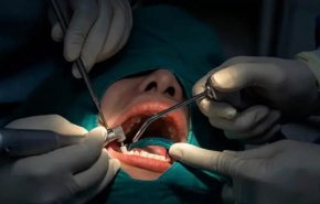 إيران تطور إسفنجة نانوية مبتكرة لجراحات الأسنان