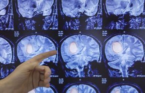 دراسة: دواء شائع قد يقضي على أحد أخطر السرطانات