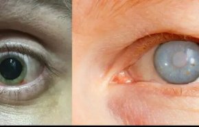 وزارت بهداشت نوار غزه : هزاران نفر در خطر نابینایی قرار دارند