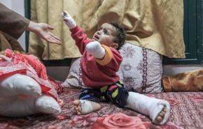 قطع عضو ۶ هزار تن از مردم غزه در جنگ اسرائیل