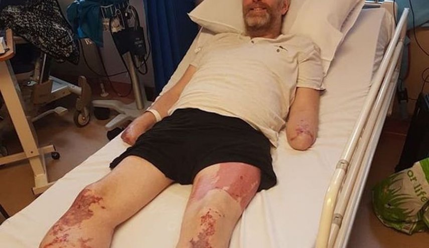 Dad lost both legs and hands after amputation - just a day after feeling like he had a cold