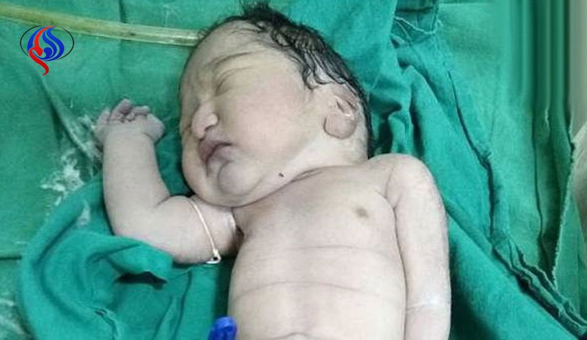 تولد نوزادی به شکل پری دریایی در هند+عکس