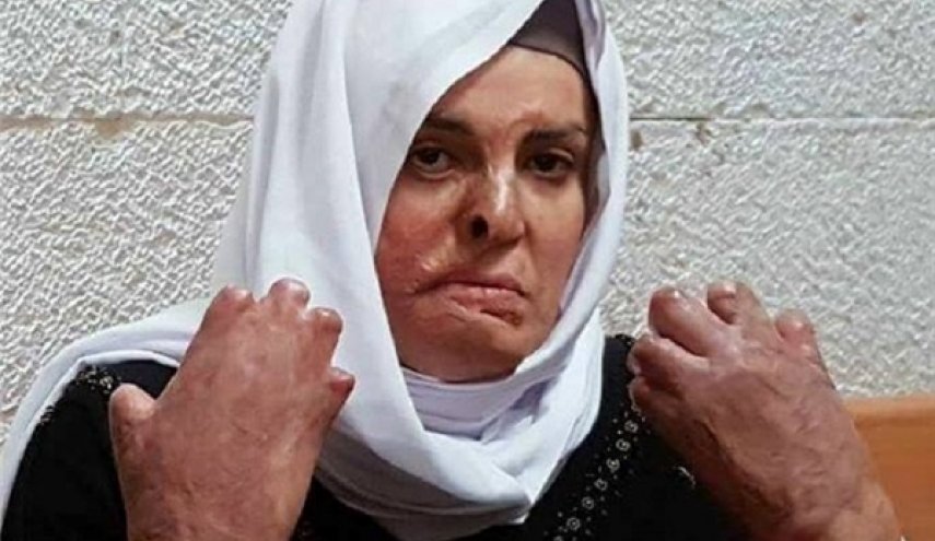 بی‌اعتنایی اسرائیل به زن اسیر فلسطینی با 50 درصد سوختگی