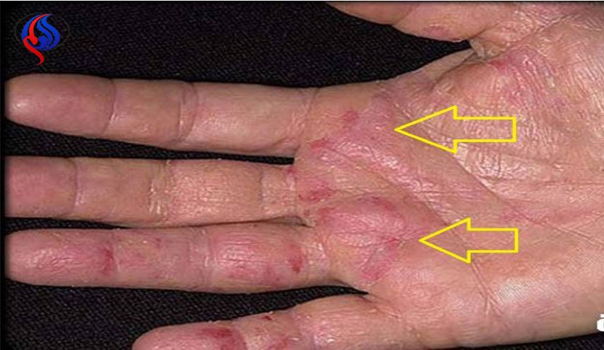 العوارض الأولى للسرطان تظهر على اليدين! كيف تكتشفونها ؟