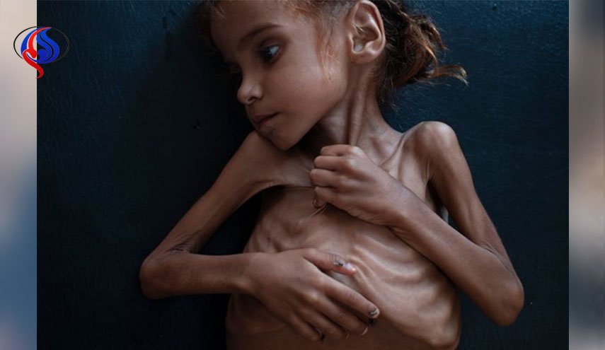  مرگ دختر یمنی که تصویرش جهان را تکان داد
