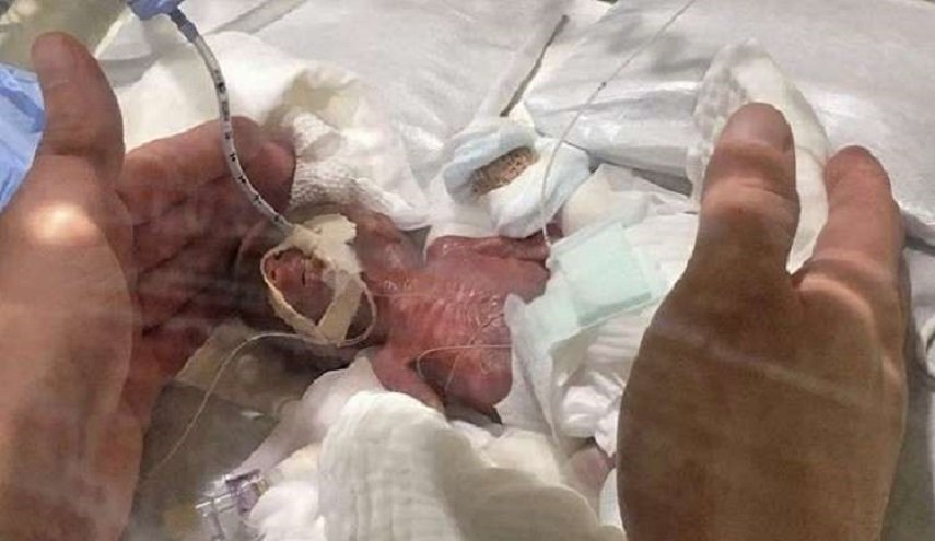 ولادة أصغر طفل في العالم بوزن يبلغ 268 غراما