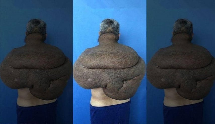 بالصور.. 33 ساعة لإنقاذ رجل من ورم سرطاني وزنه 28 كيلوغراما