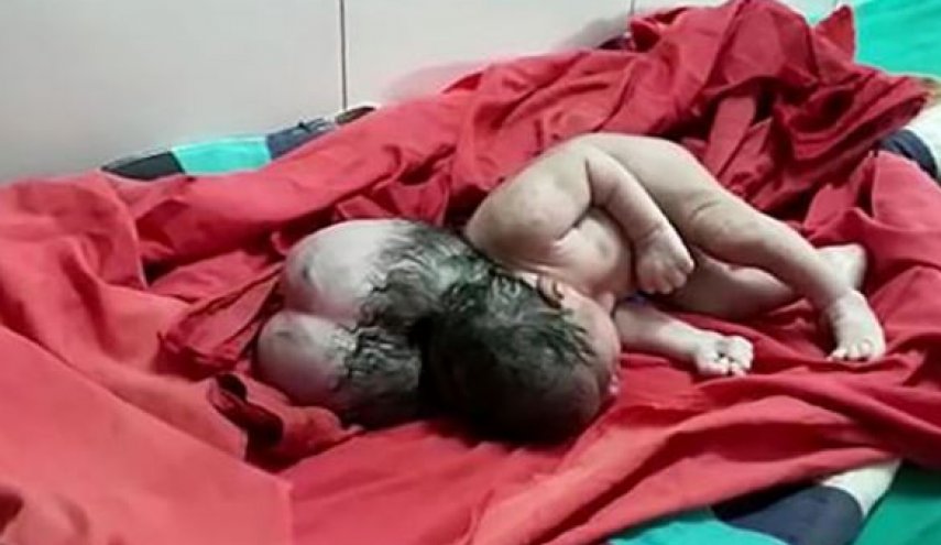 نوزادی که با 3 سر در هند به دنیا آمد 
