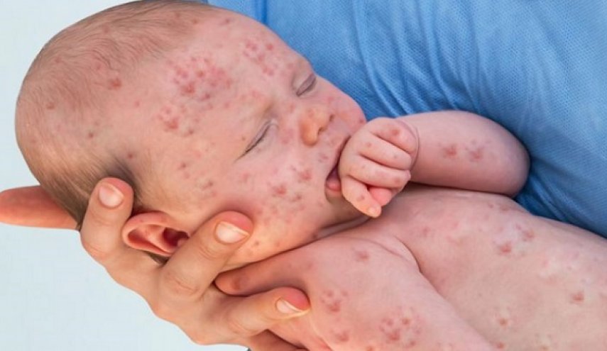 اليونيسف تحذر من تفشي مرض خطير مع الإنشغال بكورونا