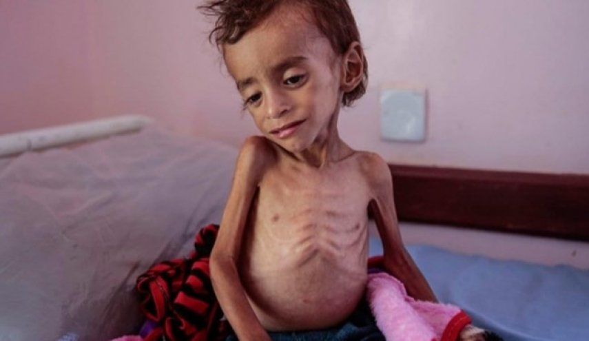 سازمان‌ملل: 400 هزار کودک یمنی در خطر مرگ به دلیل سوء تغذیه هستند
