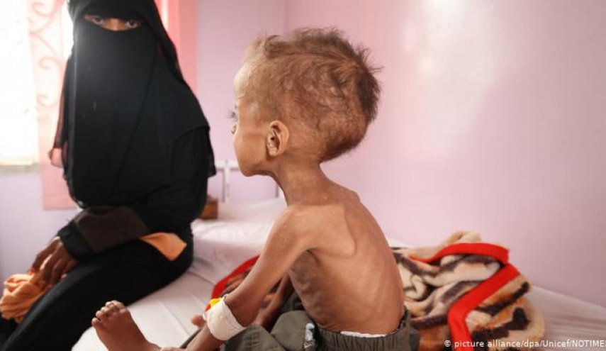 وكالات أممية : سوء التغذية الحاد يهدد نصف أطفال اليمن