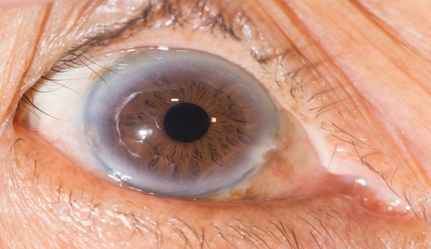 قوس قرنية العين يكشف ارتفاع مستوى الكوليسترول في الجسم