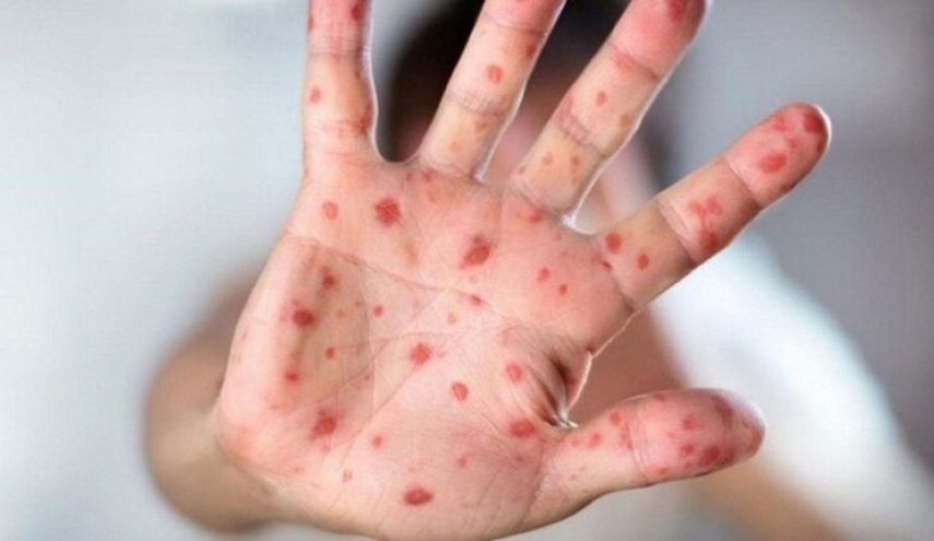 انتشار المثلية الجنسية وجدري القرود يثيران المخاوف في الإمارات