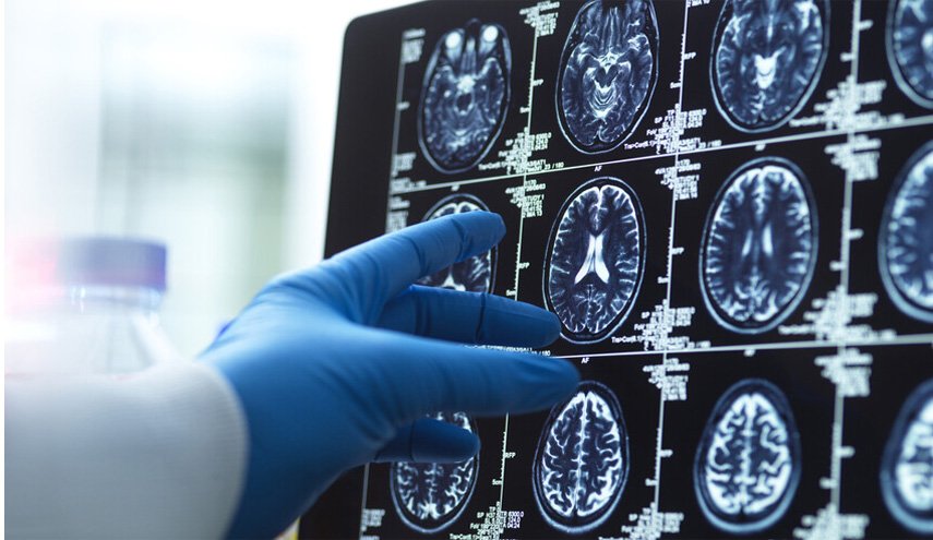 نوع من التوابل الشائعة يسهم في علاج ألزهايمر