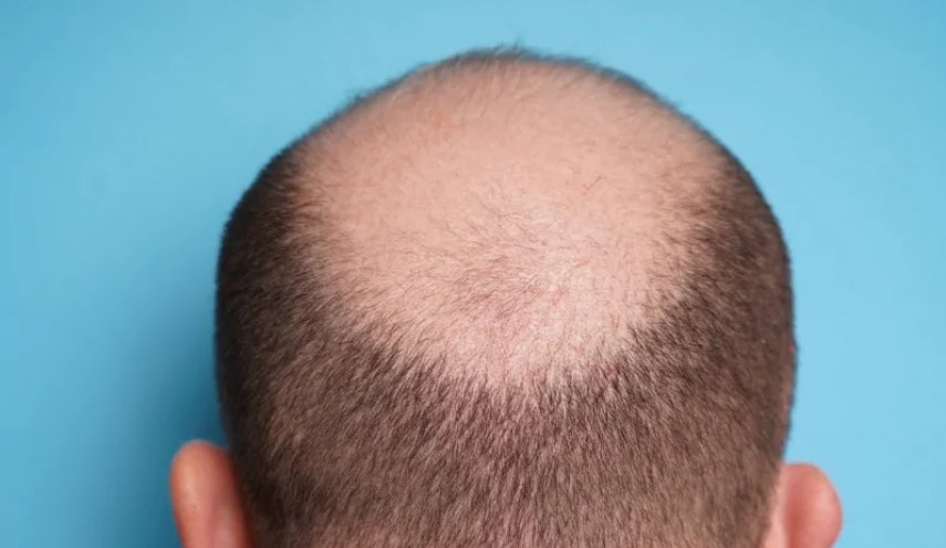 وداعاً للصلع.. إنبات الشعر خلال 20 يوماً فقط!