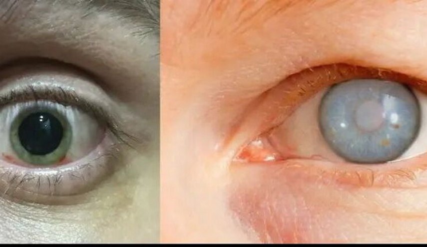 وزارت بهداشت نوار غزه : هزاران نفر در خطر نابینایی قرار دارند