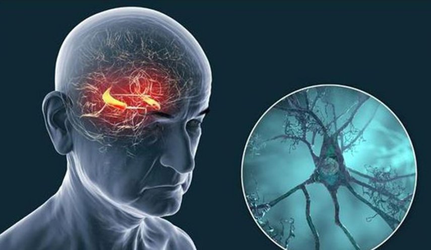 مفاجأة علمية.. ألزهايمر يؤثر في نخاع العظم ويضعف الاستجابة المناعية