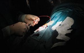 عملية جراحية لاستئصال مرارة على ضوء الجوال