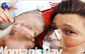 تصاویر؛ تولد نوزاد دو سر در استرالیا