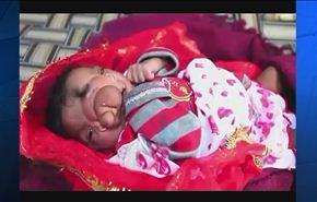 بالفيديو، طفلة هندية تولد بخرطوم فيل وأهلها يفرحون بذلك