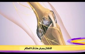 الأطفال ومرض هشاشة العظام