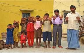 جهش ژنتیکی 100 انگشت به خانوادۀ هندی اضافه کرد! (تصاویر)
