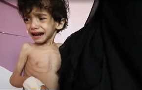 جوع أطفال اليمن يفضح نفاق الغرب المتباكي على حلب