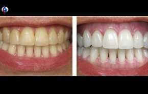 سفید کردن دندانها با روشی طبیعی