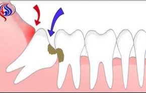 چه زمانی باید دندان عقل‌تان را جراحی کنید؟