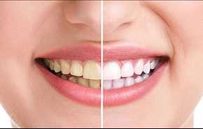 چهار روش طبیعی برای سفید کردن دندان ها