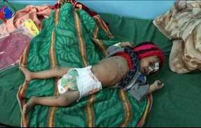 هر 10 دقیقه یک کودک یمنی می‌میرد!!