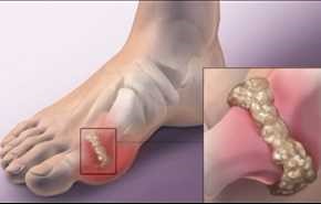 اسباب مرض النقرس